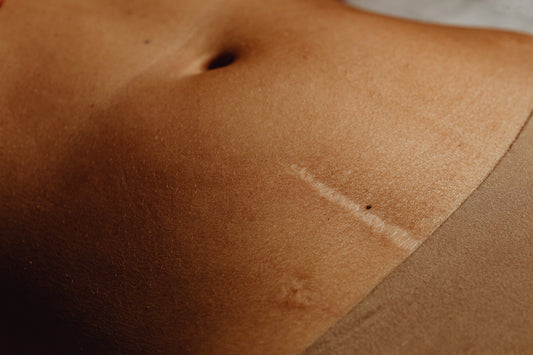 L'endométriose : une maladie invisible, une douleur bien réelle